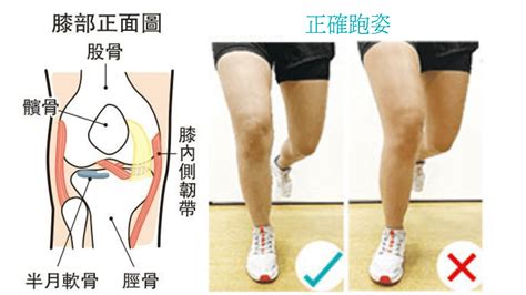 【膝痛】跑步姿勢不當3原因 肌肉不平衡扁平足致膝關節內旋正確跑姿話你知 姿錯能改 明報健康網