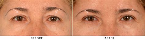 Upper Lid Blepharoplasty Before And After Photo Gallery