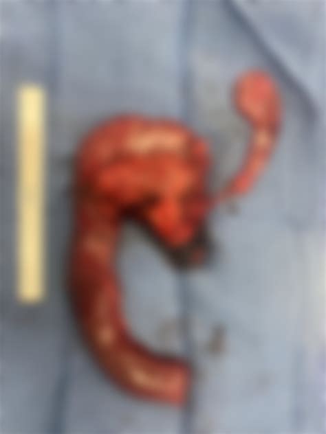 Specimen From A Whipple Procedure Medicalgore