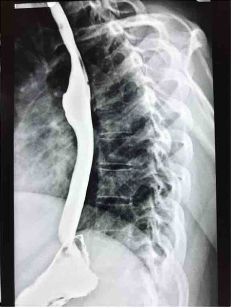 Figure 6 Normal Barium Esophagogram After Completion Of The Treatment