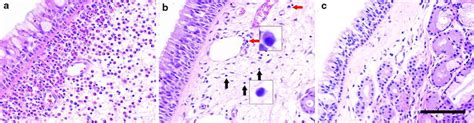 Nasal Polyps Histology