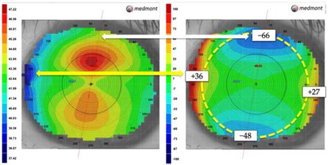 Jcm Free Full Text To Achieve A Bullseye Factors Related To Corneal Refractive Therapy