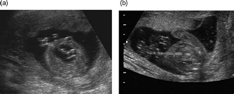 Vesicoamniotic Shunting Using A Double‐basket Catheter Appears Effective In Treating Fetal