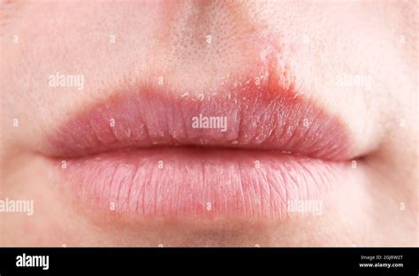 Herpes Blisters On Female Lips Closeup Stock Photo Alamy