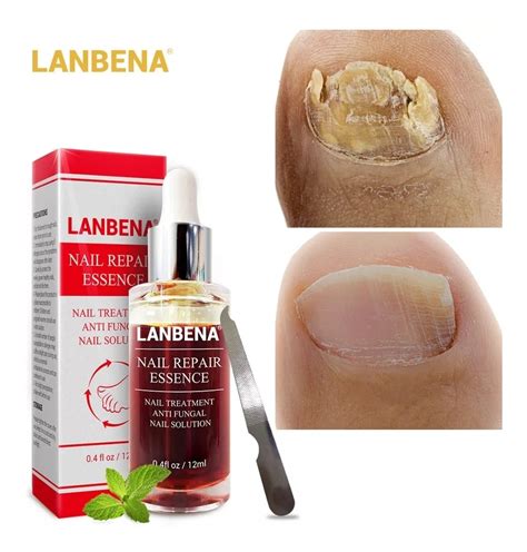 Lanbena Serum Tratamiento De Uñas Con Hongos Onicomicosis Mercado Libre