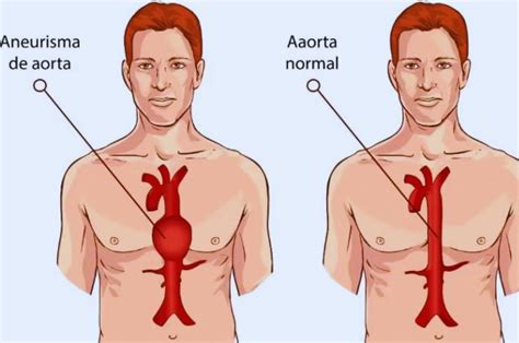 Aneurisma De Aorta Causas S Ntomas Y Tratamientos