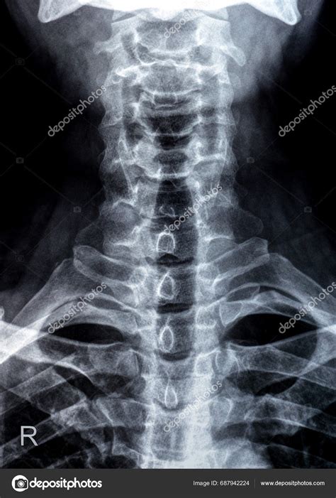 Plain Ray Cervical Spine Revealed Straightened Cervical Curve