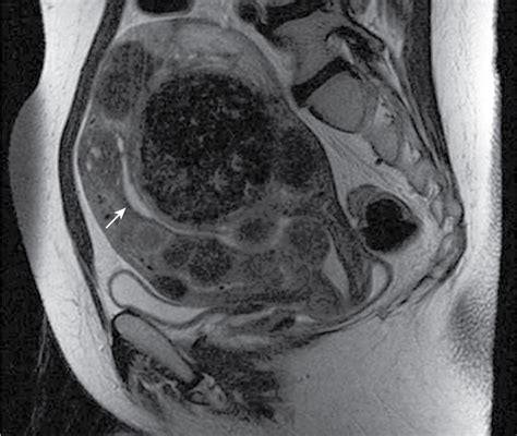 Myometrium Is Homogeneous