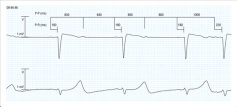 Atrioventricular Block With 21 Conduction—discussion Cardiology Jama Internal Medicine