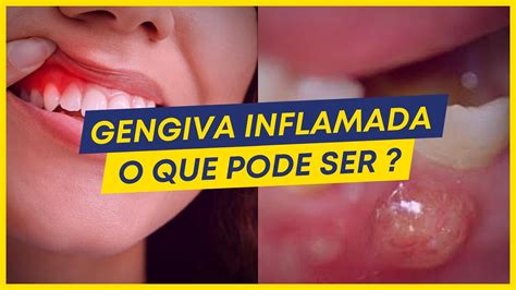 Coisas Que Fazem A Sua Gengiva Inflamar Como Resolver Youtube