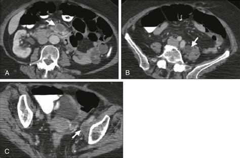 Cancers Of The Cervix Vulva And Vagina Oncohema Key