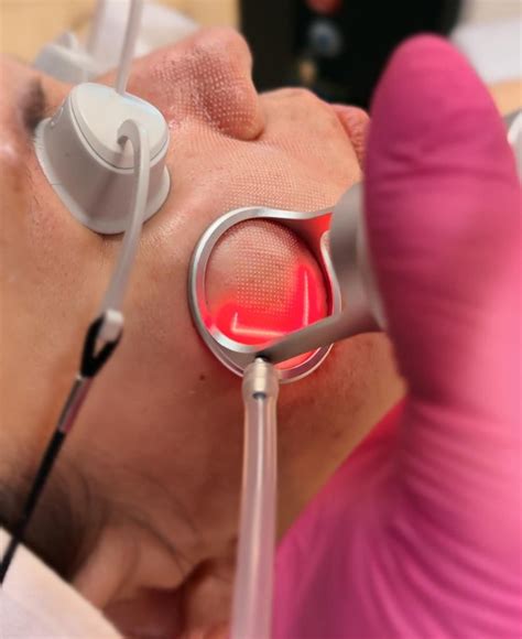 Laser Frakcyjny Co Presti Skin Clinic Presti Instytut Urody