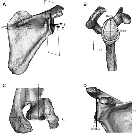 Glenoid Morphology In Reverse Shoulder Arthroplasty Classification And