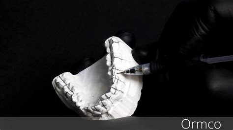 С.А.Попов: Позиционирование брекетов на гипсовой модели, изготовление ...