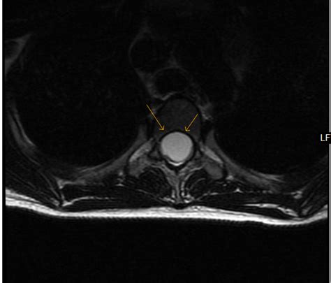 Spinal Intradural Arachnoid Cyst Mri Sumers Radiology Blog