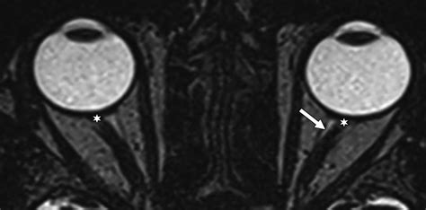 Normal Optic Nerve Mri