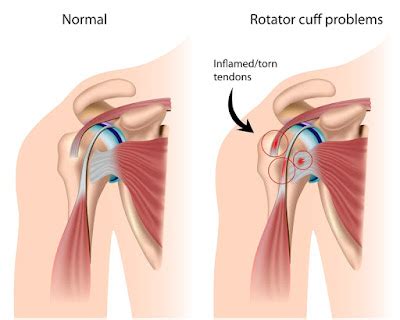 Rotator Cuff Injury Treatments Symptoms And Diagnosis