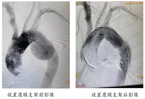 山东省第二人民医院（山东省耳鼻喉医院）开展首例局麻下、单开窗胸主动脉覆膜支架腔内隔绝术，为患者妙解“定时炸弹”腾讯新闻