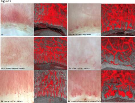 FRI0370 Three Dimensional Nailfold Capillary Imaging By Dynamic Optical