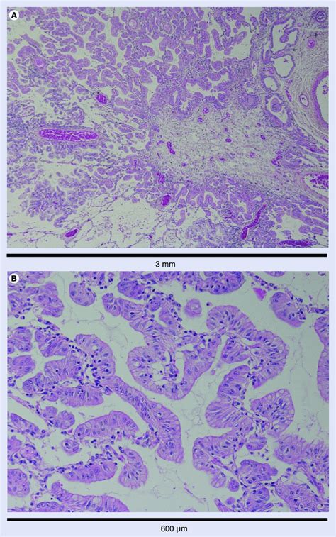 Invasive Mucinous Adenocarcinoma Of The Lung A 3 Mm Low Download Scientific Diagram