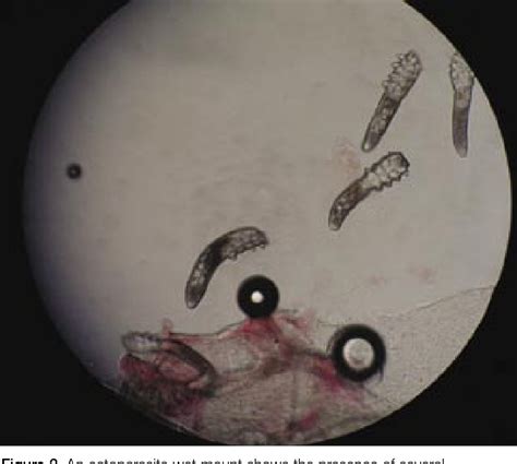 Figure 1 from Resistant scalp folliculitis secondary to Demodex infestation. | Semantic Scholar