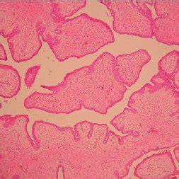 Photomicrograph Of Benign Phyllodes Tumour Showing Leaf Like