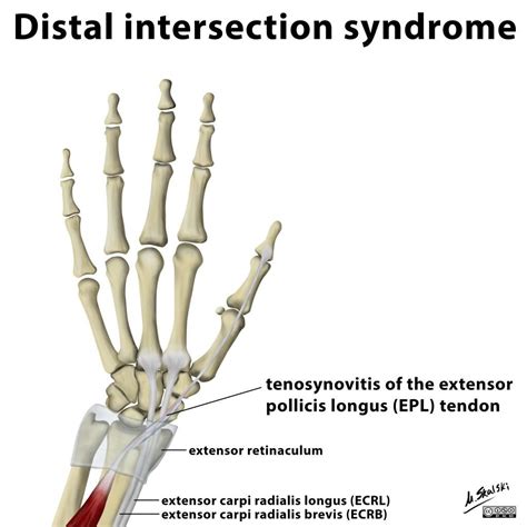 The Distal Intersection Syndrome Relates To Tenosynovitis Of The