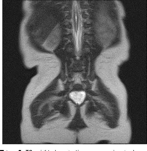 Figure 2 From Congenital Aphallia Review Of Pathogenesis And Current