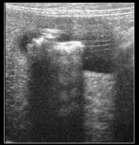 Hepatobiliary Imaging With Radiography And Ultrasonography Biliary