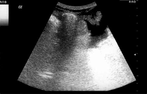 Free Fluid Next To The Appendix In The Right Iliac Fossa Download Scientific Diagram