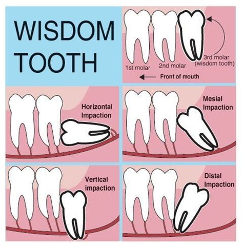 Dentaltown A Wisdom Tooth Or Third Molar Is One Of The Three Molars