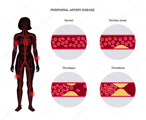 Enfermedad arterial periférica 2022