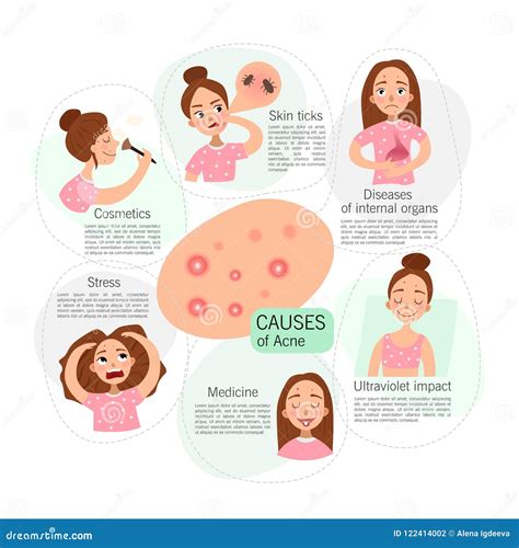 Acne Infographics Causes Stock Vector Illustration Of Defect 122414002