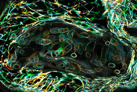 Schistosomiasis