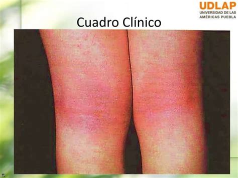 Dermatitis Atópica Y Eccema Numular Sin Videos Ppt