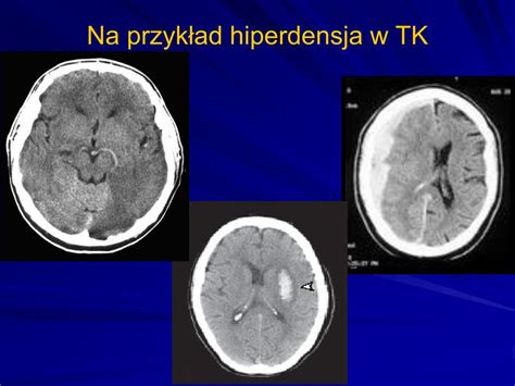 PPT Postępowanie z pacjentem z udarem niedokrwiennym w warunkach