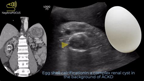 The Pocus Kingdom Nephropocus