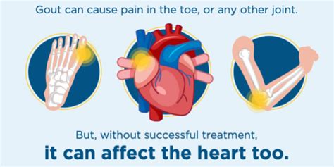 Infographics Alliance For Gout Awareness