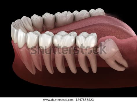 Healthy Teeth Wisdom Tooth Mesial Impaction Stock Illustration 1247858623