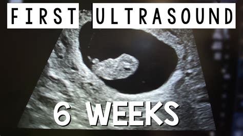 First Pregnancy Ultrasound At 6 Weeks Telling Our Kids Were Pregnant