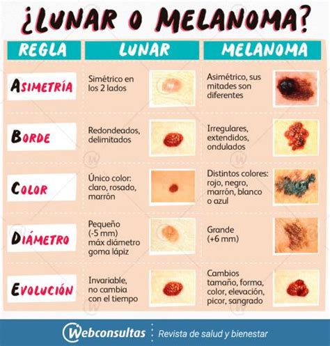 C Mo Identificar Un Melanoma Regla Abcde Pruebas Y Localizaci N