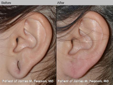 Photo Gallery Reconstructive Dr James Pearson Facial Plastic Surgery