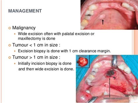 Salivary gland tumor