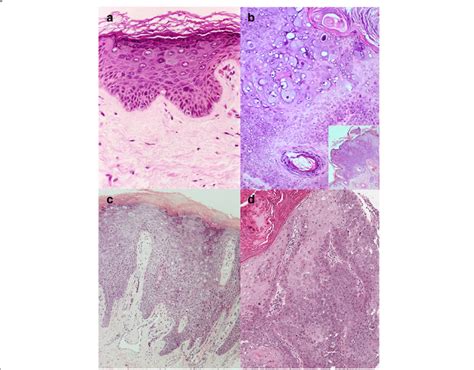 Examples Of Cytopathic Effect In Epidermodysplasia Verruciform Ev In