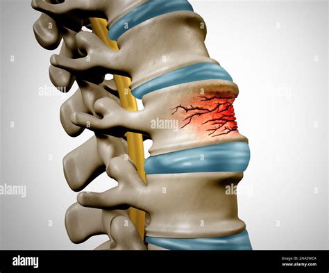 Traumatic Spine Fracture And Vertebral Injury Medical Concept As A