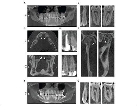 Radiographic Findings A Panoramic X Ray From Proband II 1 Showing