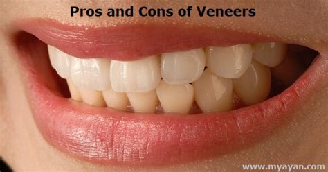 Pros And Cons Of Veneers Bright Glistening Teeth