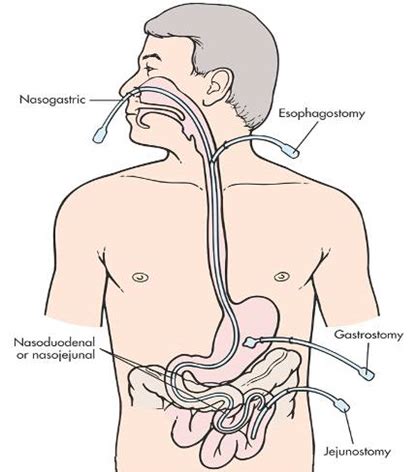 Enteral Parenteral Nutrition Flashcards Quizlet