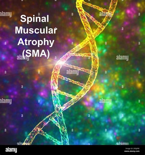 Atrophie spinale musculaire SMA un trouble neuromusculaire génétique