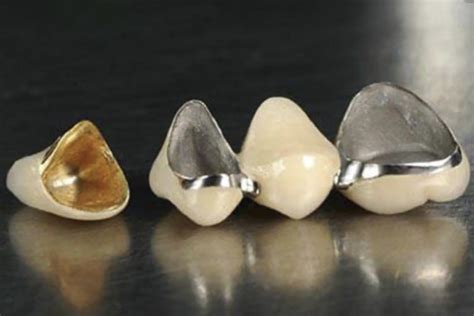 Pfm Porcelain Fused To Metal Sam S Dental Laboratory